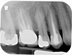 Root Canals