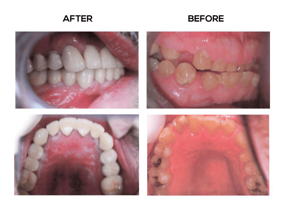 Full Mouth Reconstruction, Before and After